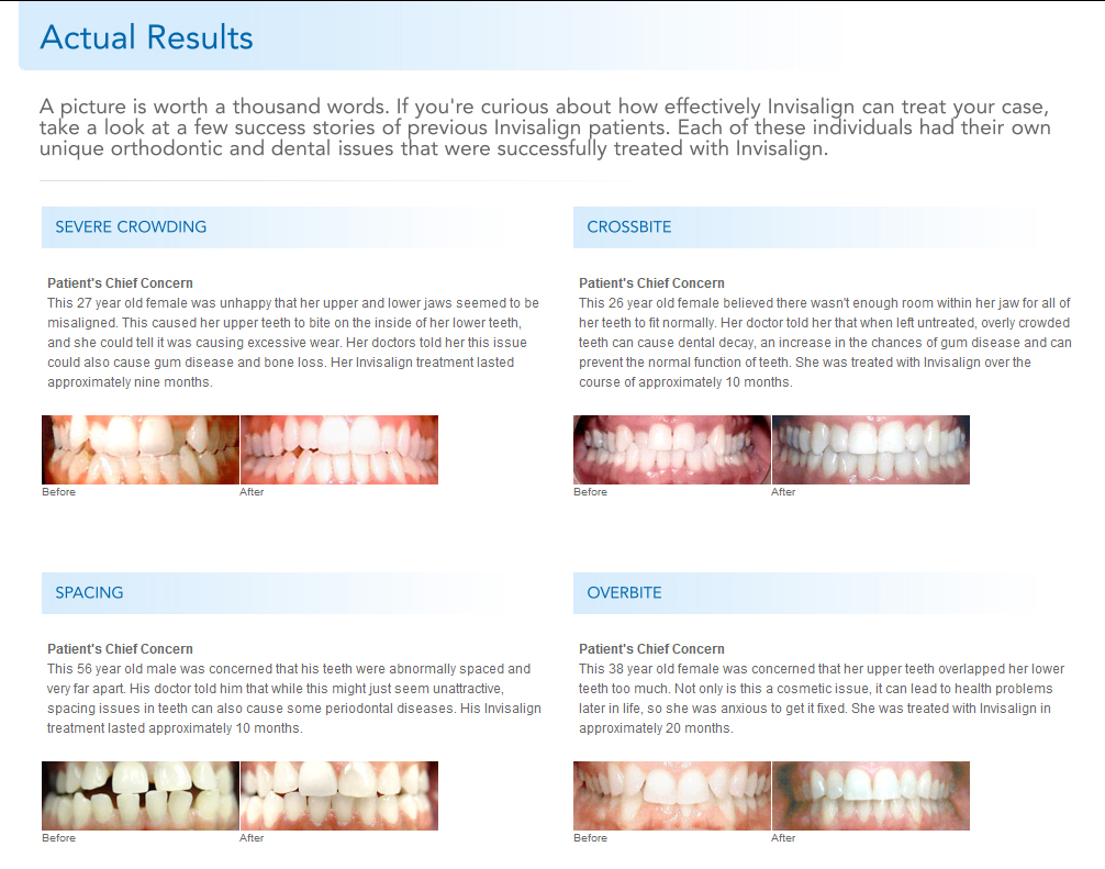 Invisalign - Rejuvenate your Smile!Rejuvenate your Smile!